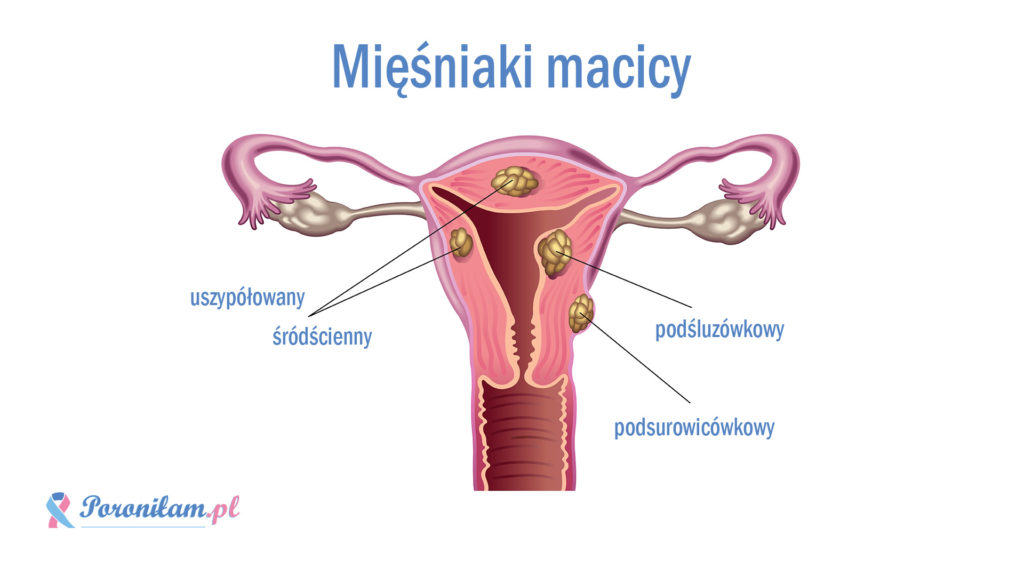 mięśniaki macicy